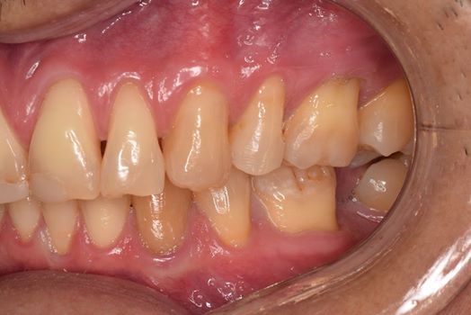 Que es la cirugia plastica periodontal